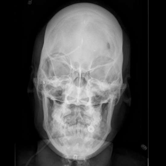 X-Ray Skull AP View, Preparation, Procedure, and the Requirements
